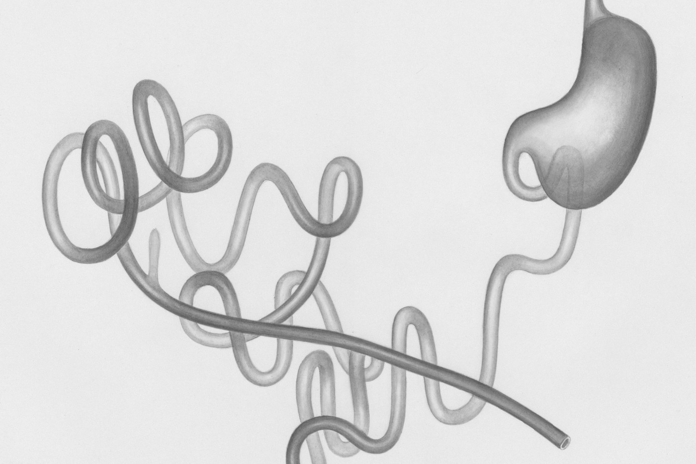 Виразка дванадцятипалої кишки: Helicobacter pylori, НПЗП і загоєння слизової